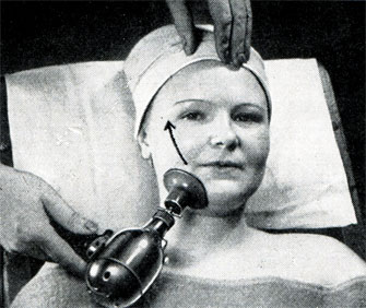 Рис. 345. Вибрационный массаж наконечником-колокольчиком