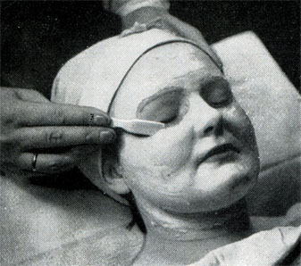 Рис. 350. Отделение маски от лица, начиная от нижнего края глазной орбиты и до скуловой кости