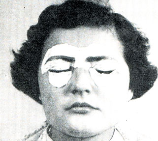 Рис. 367. Здесь ясно видны как мазь для защиты, так и оба кусочка ваты под веками бровей