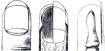 Рис. 389. Расчленения ногтя