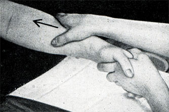 Рис. 404. Исходное положение при массаже руки
