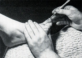 Рис. 409. Очищение ногтевого желобка