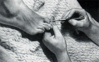 Рис. 410. Освобождение кожицы над лункой ногтя
