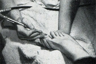 Рис. 412. Укорачивание ногтя грубым фрезером