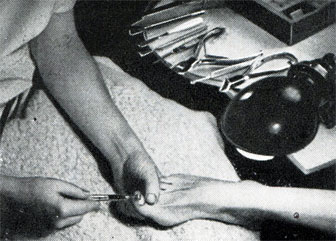 Рис. 413. Шлифовка края ногтя мелким фрезером