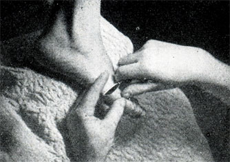Рис. 416. Срезание мозоля