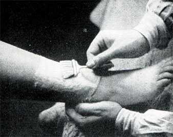 Рис. 422. Парафиновое укутывание для сохранения тонкости ног
