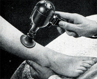 Рис. 423. Вибрационный массаж ноги