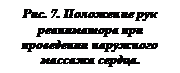 Подпись: Рис. 7. Положение рук реаниматора при проведении наружного массажа сердца.