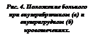 Подпись: Рис. 4. Положение больного при внутрибрюшном (а) и внутригрудном (б) кровотечениях.