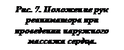 Подпись: Рис. 7. Положение рук реаниматора при проведении наружного массажа сердца.
