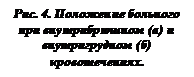 Подпись: Рис. 4. Положение больного при внутрибрюшном (а) и внутригрудном (б) кровотечениях.
