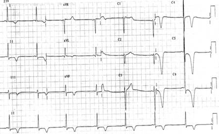 http://glenmarkcardiaccentre.co.in/wp-content/uploads/2012/03/HCM-ECG2.png