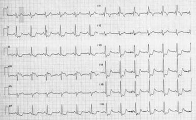 http://www.cardiologyres.org/index.php/Cardiologyres/article/viewFile/151/171/1448